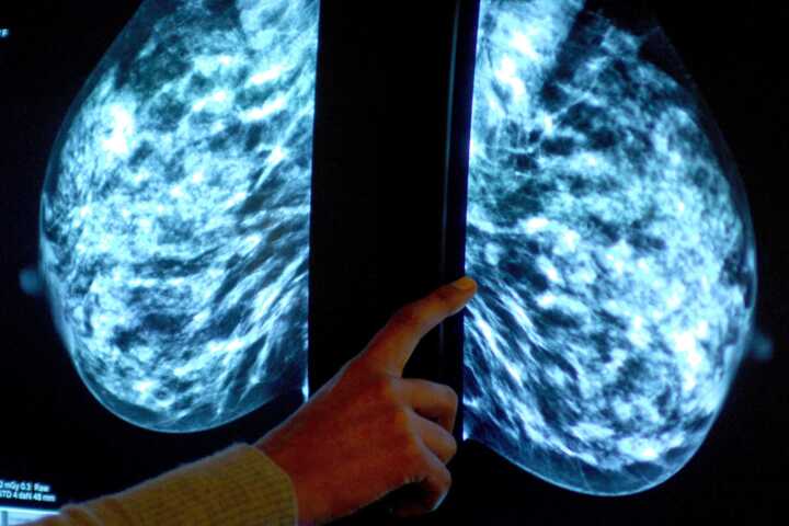 UK launches major AI trial to revolutionize breast cancer screening